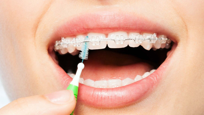Do you have braces or have you ever had braces?