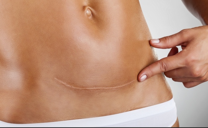 Do you have a c section scar?