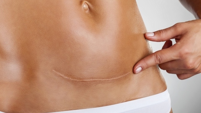 Do you have a c section scar?