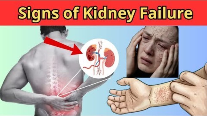HEALTH ALERT: Kidney Failure - 8 Signs That Your Kidney's Need Help! Do you have any of the signs?
