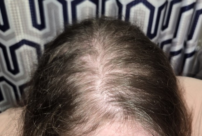 I think Im balding?