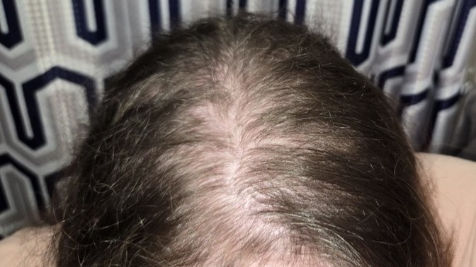 I think I'm balding?