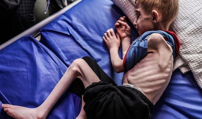 A starving child from Gaza, courtesy the MAGA vote, Cheeto Mussolini and B. Nethanyahu.