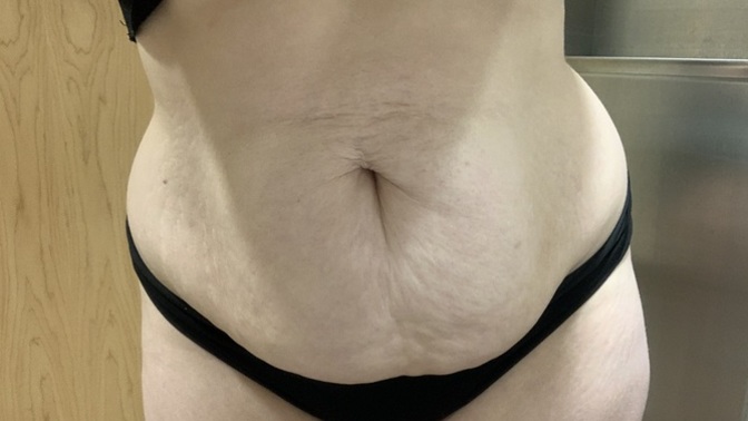 Guys would you date a girl with loose skin and an apron belly?