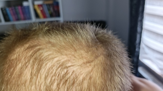 Does my hair regrow?