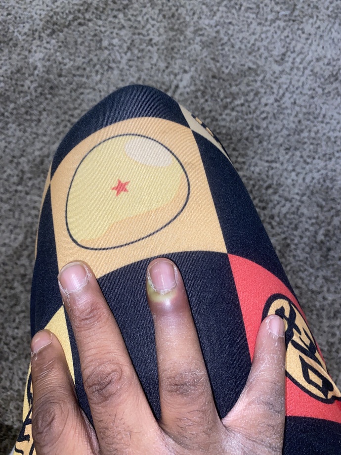 My finger is swollen I don’t remember hurting it?