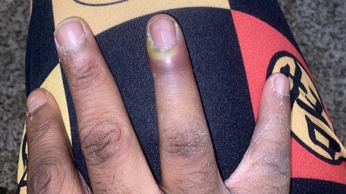 My finger is swollen I don’t remember hurting it?