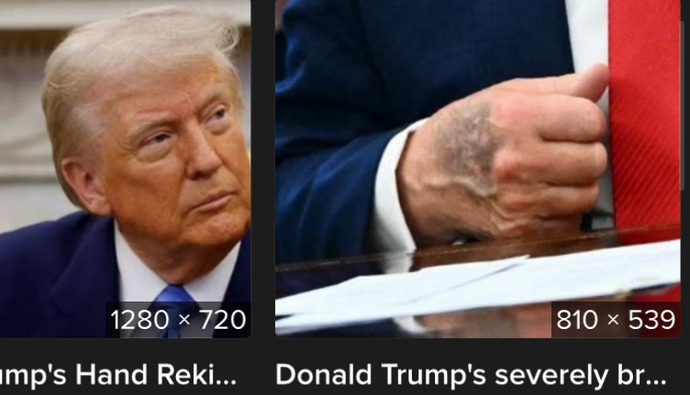 Heavy hand bruising similar to the Queens before her death