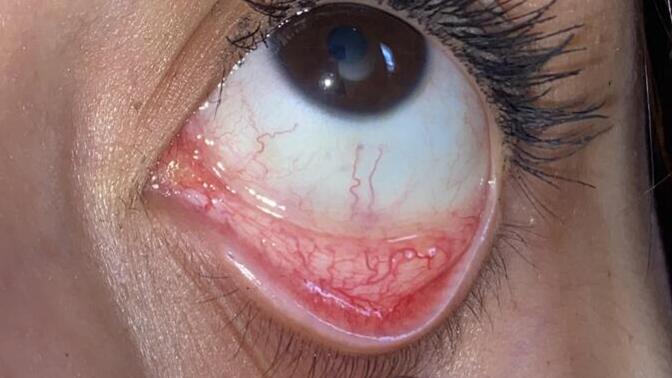 Are eyes like these healthy looking in your opinion?