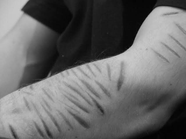 Would you date someone who has self harm scars on their arms?