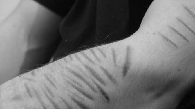 Would you date someone who has self harm scars on their arms?