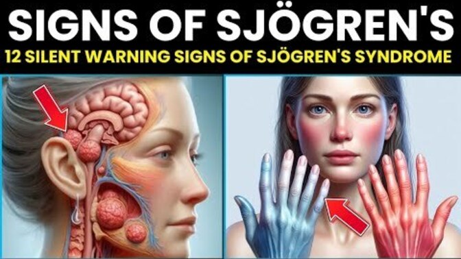 URGENT! Symptoms of Sjogrens Syndrome You Cannot Ignore. Do You Have Any Of These Symptoms?