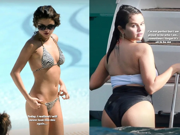 Selena Gomez has Lupus. Is it serious or another made up celebrity illness like lime disease?