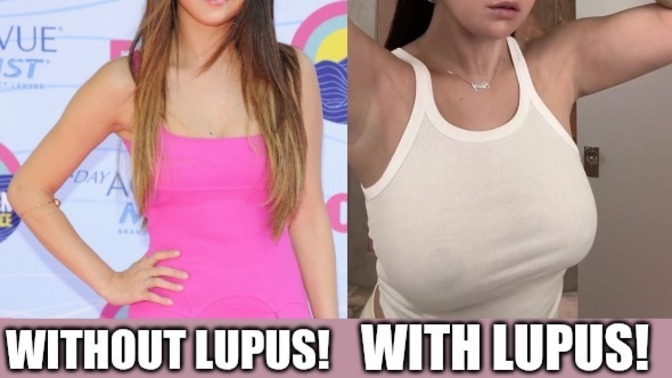 Selena Gomez has Lupus. Is it serious or another made up celebrity illness like lime disease?