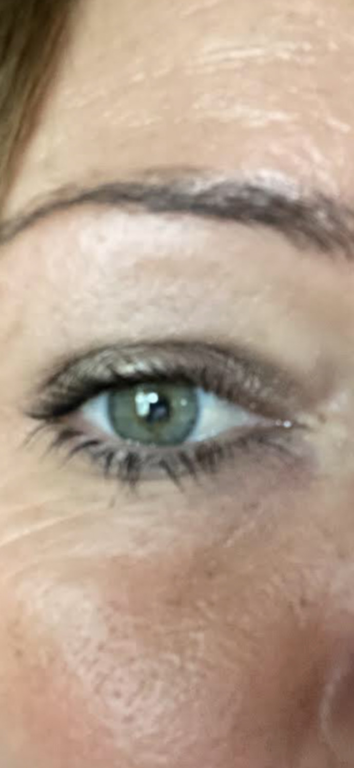 I’m not sure if you can see it but I have a sty in my eye, what’s the best thing to do for it?