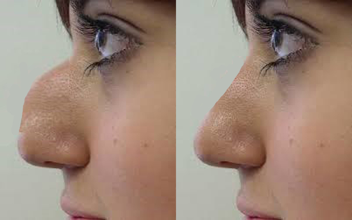 Would you date someone who has had some form of plastic surgery?