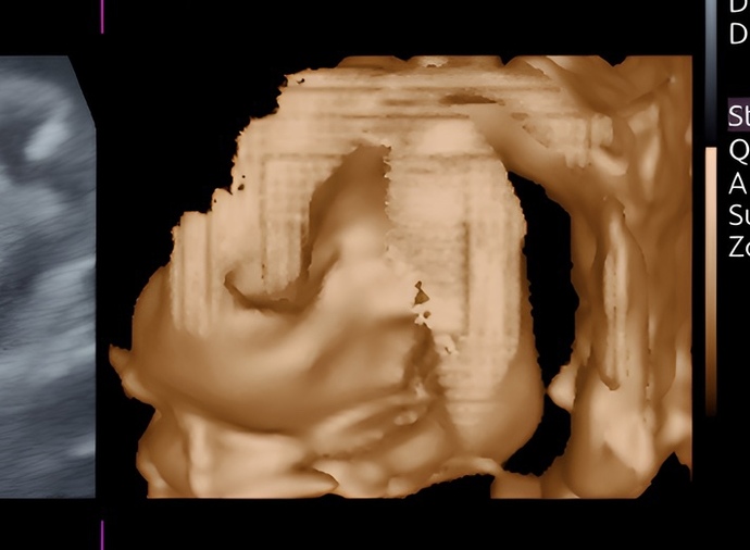 3d ultrasound FAIL?