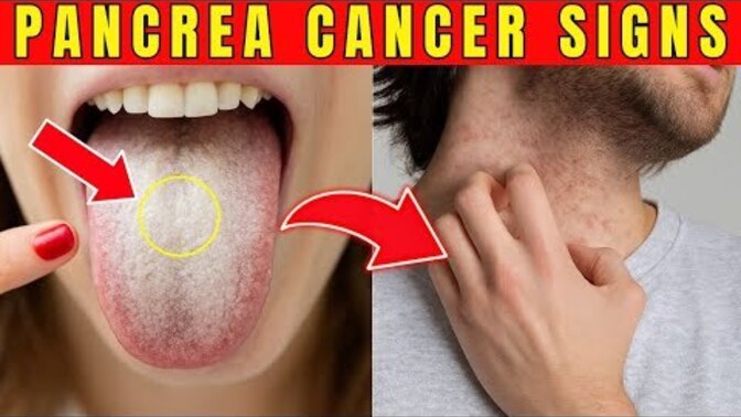 8 Strange Signs of PANCREATIC Cancer. Do you want to know the strange signs?