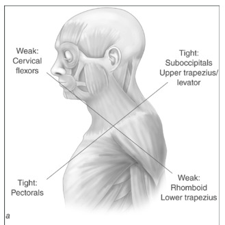 Upper Cross syndrome- tight areas make "X" with the weak ones.