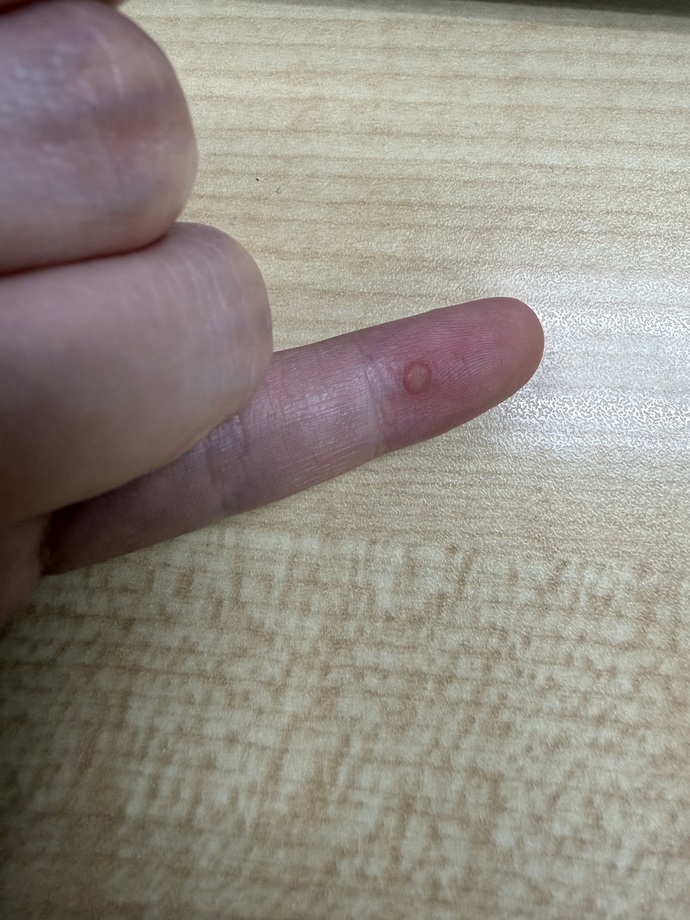 What the heck is this bump on my finger?