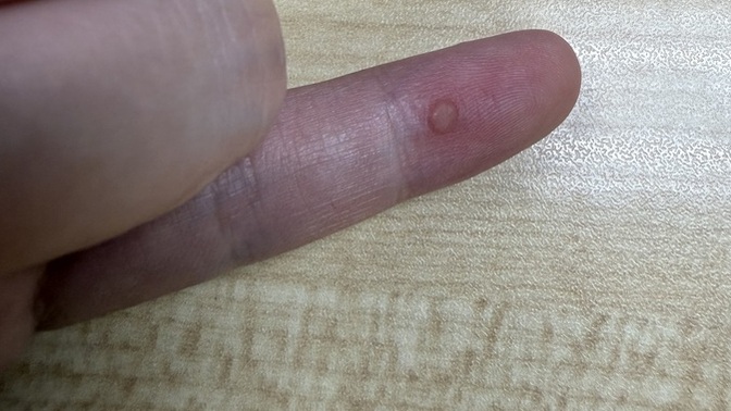 What the heck is this bump on my finger?
