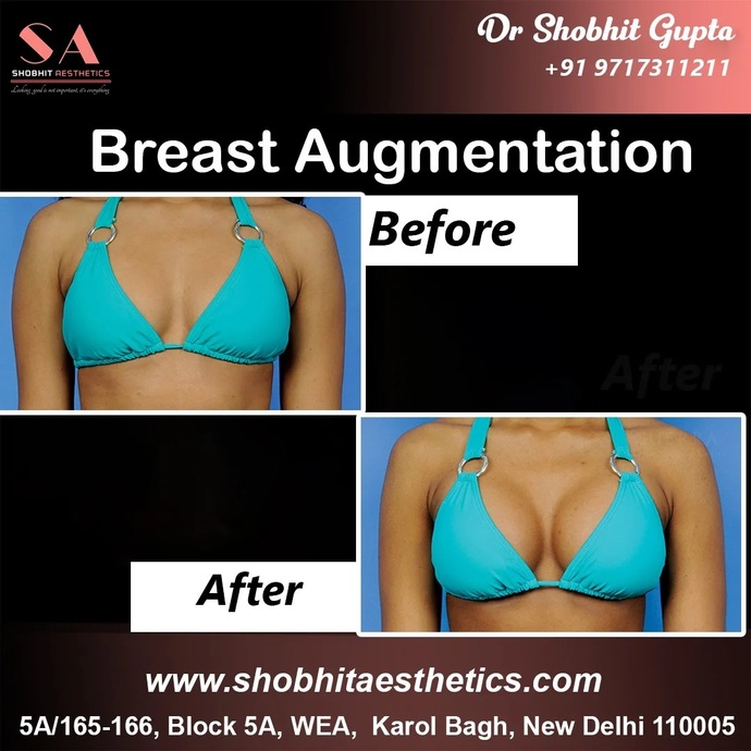 Why do so many women with A and even B cup breasts chose to have breast implants when most men tell me that they dont even like big breasts?