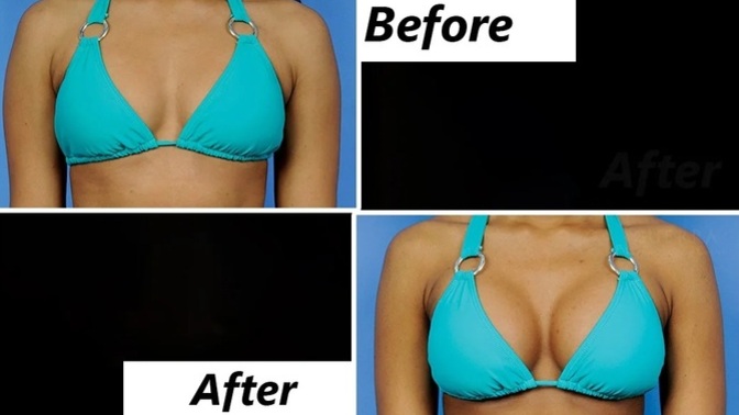 Why do so many women with A and even B cup breasts chose to have breast implants when most men tell me that they don't even like big breasts?