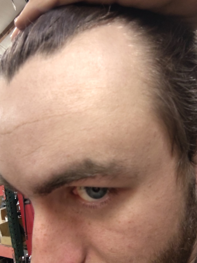 Is it normal to have a receding hairline at 20 years old?
