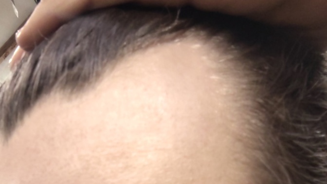 Is it normal to have a receding hairline at 20 years old?