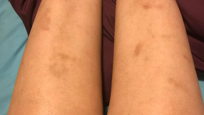 What should I do to get rid of rash on my legs?