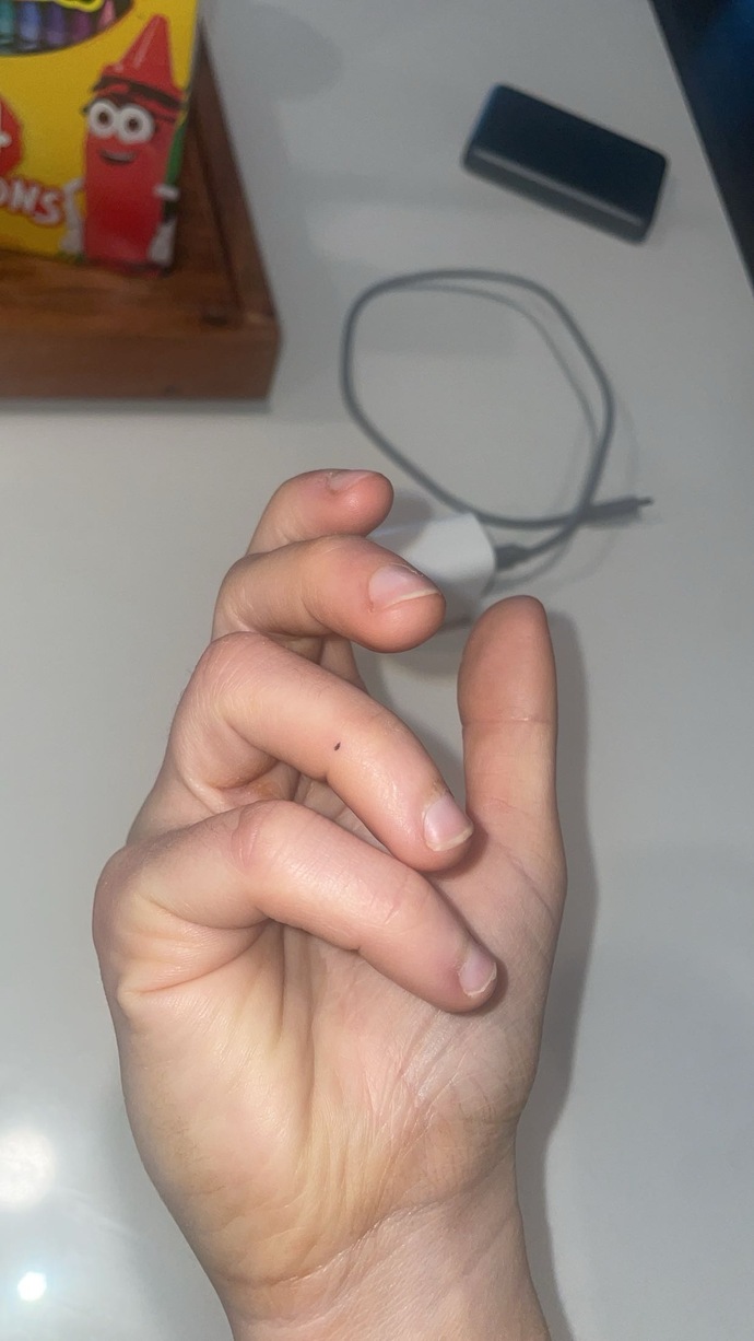 Cancer or just a mole?