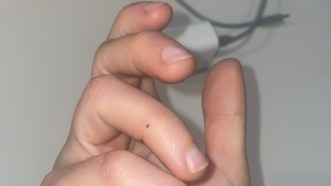 Cancer or just a mole?