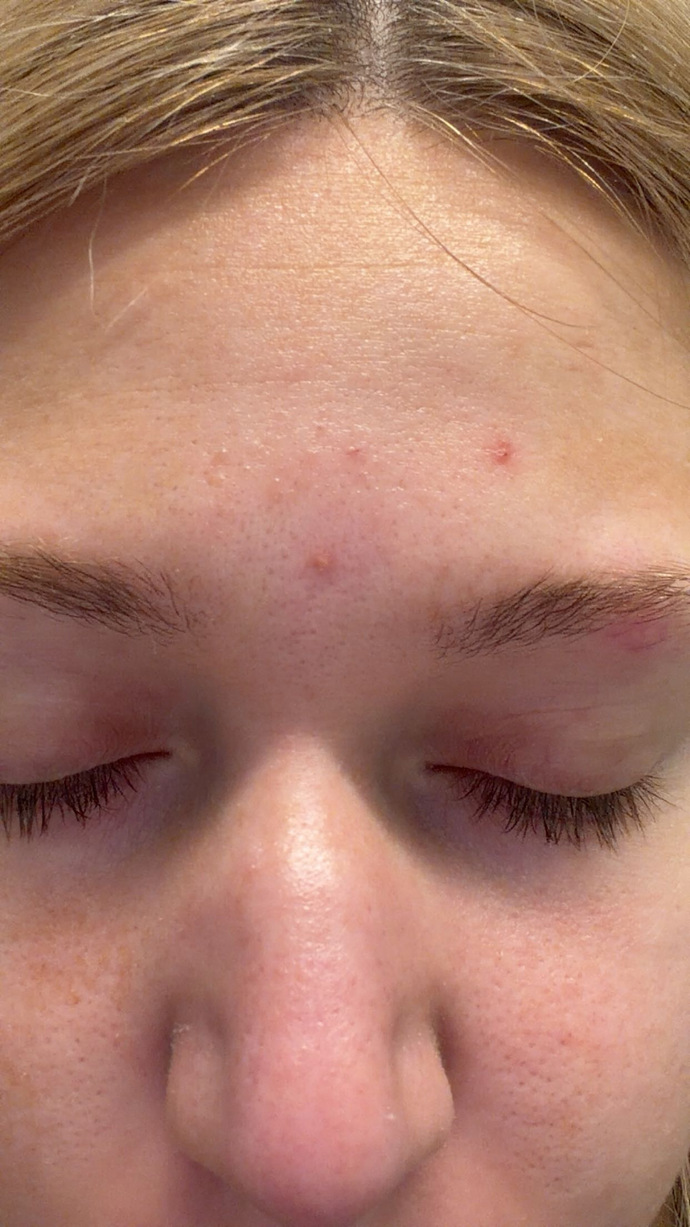 Acne flare up, it’s been like this for two weeks any suggestions?