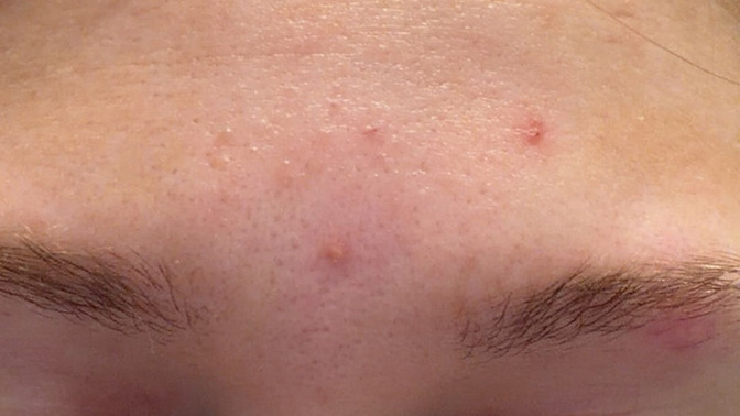 Acne flare up, it’s been like this for two weeks any suggestions?