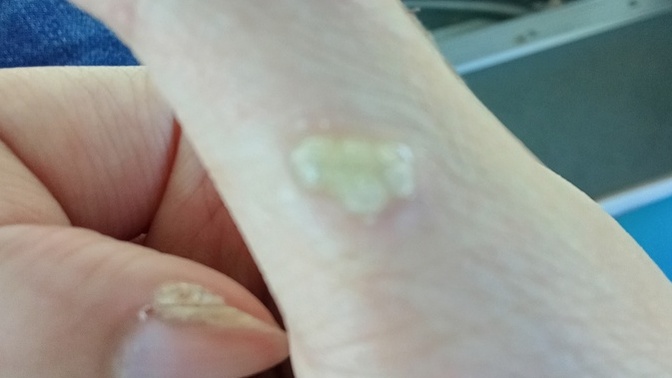 What is this illness?