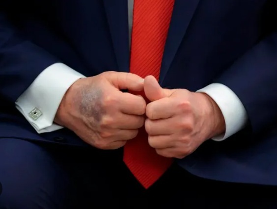 Trump is rotting. Why?