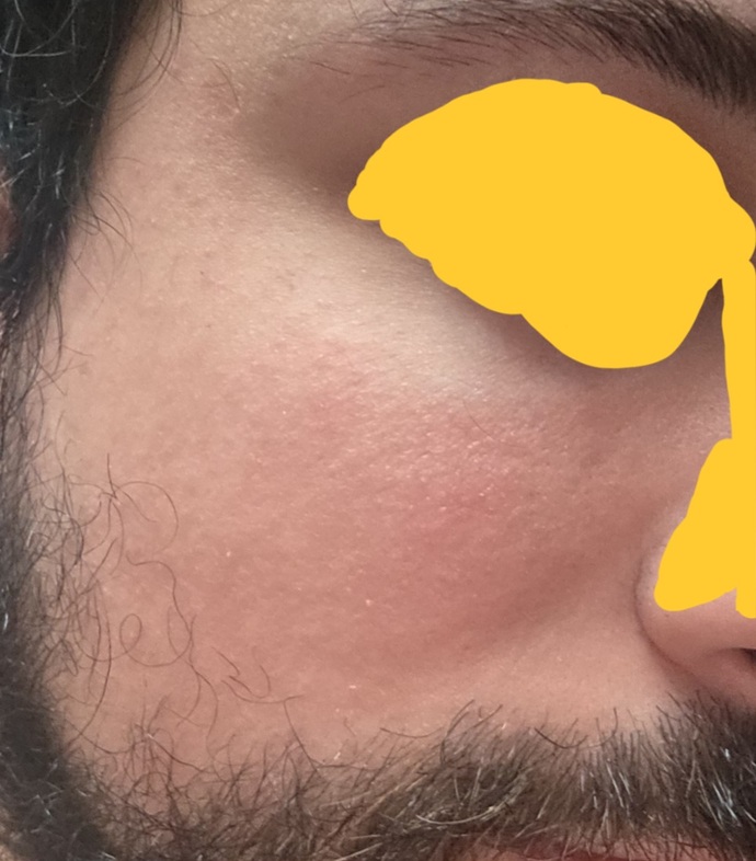 Is my facial redness seborrheic dermatitis or rosacea?