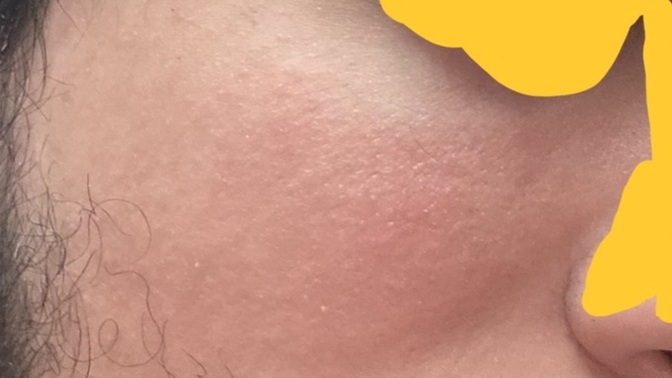 Is my facial redness seborrheic dermatitis or rosacea?