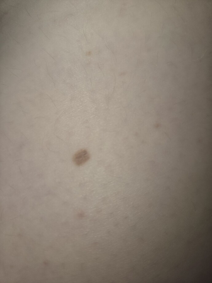 Does this spot look like a normal freckle or melanoma?