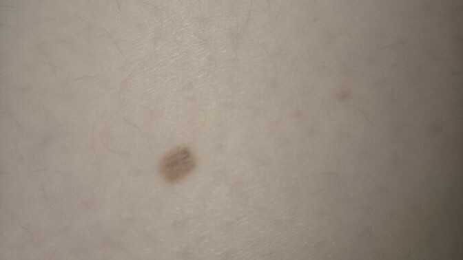 Does this spot look like a normal freckle or melanoma?