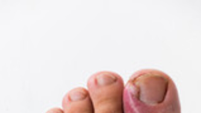 Did you ever have an ingrown toenail?