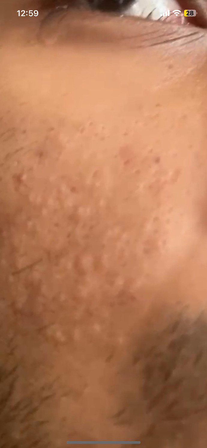 What skin condition is this?
