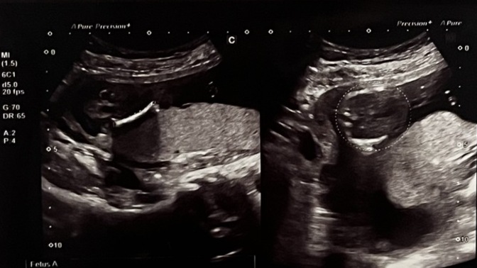 How can I tell if this ultrasound scan shows a boy or a girl?