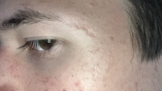 Girls, is this kind of facial scar actually attractive on a guy?