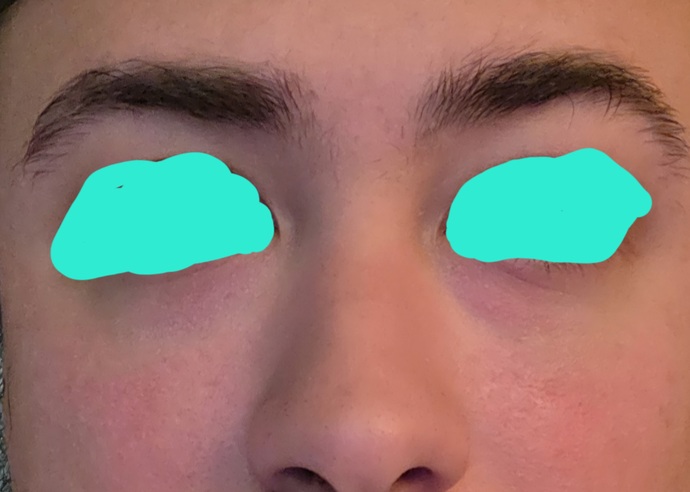 Does noticeable cheek redness make someone less attractive to you?