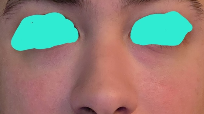 Does noticeable cheek redness make someone less attractive to you?