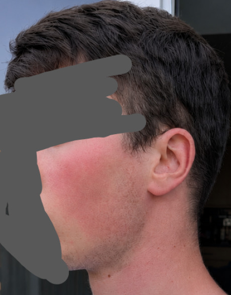 Girls, is it fine if a guy has red cheeks and blushes? Is it a turn off?