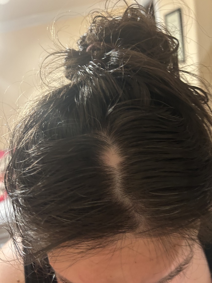 Just washed my hair and found a weird new spot on my scalp—should I worry?