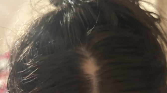 Just washed my hair and found a weird new spot on my scalp—should I worry?