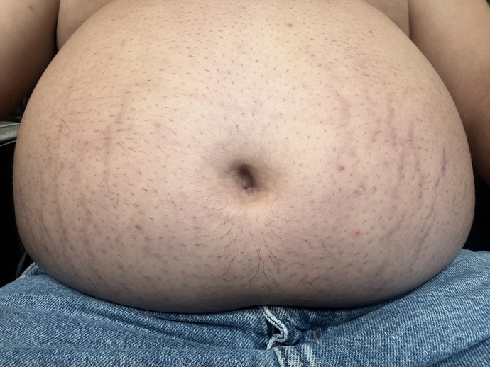 Women who had pregnancy stretch marks: what lotion actually works?